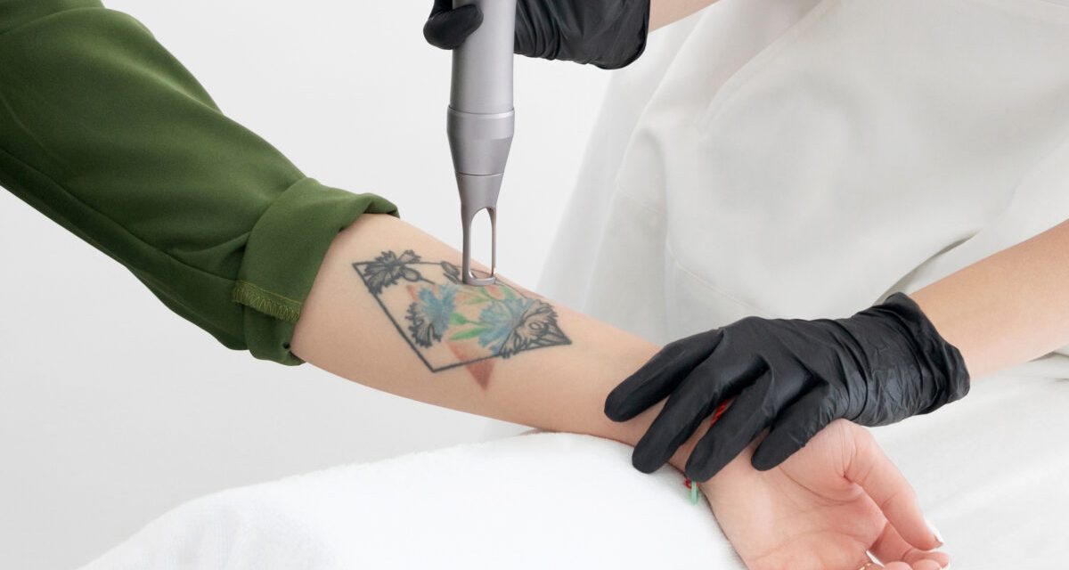Penghapusan Tato Yang Cukup Sakit Dan Berbekas