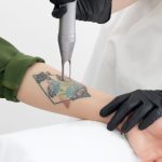 Penghapusan Tato Yang Cukup Sakit Dan Berbekas