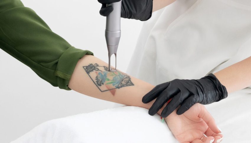 Penghapusan Tato Yang Cukup Sakit Dan Berbekas