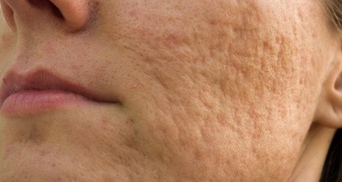 Tekstur Kasar Pada Kulit Wajah Yang Bopeng