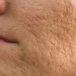 Tekstur Kasar Pada Kulit Wajah Yang Bopeng