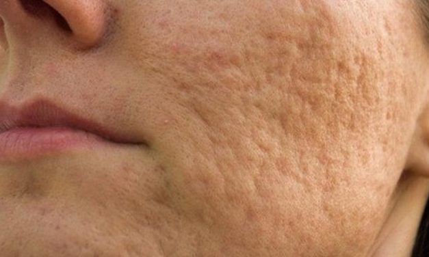 Tekstur Kasar Pada Kulit Wajah Yang Bopeng