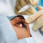 Prosedur Pembedahan Mata Dengan Melakukan Tindakan Lasik