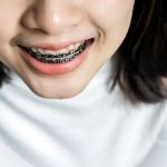 Sebuah Gaya Behel Dengan Perawatan Gigi